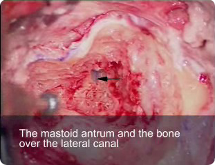 Mastoid antrum